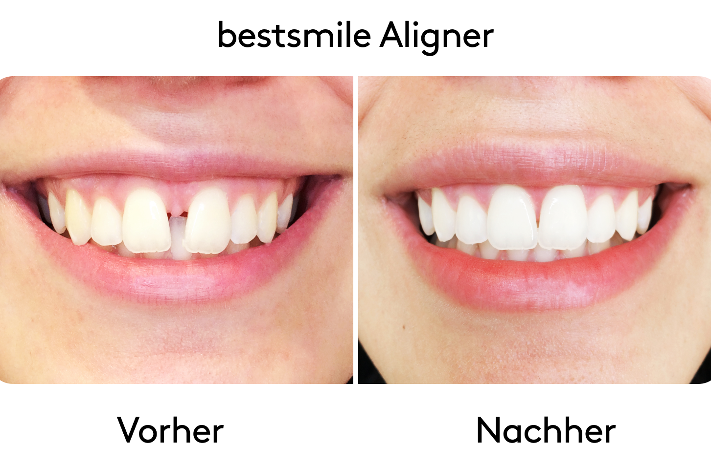 aligner-before-after-slideshow-de-4